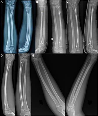 Comparison of three fixation methods in paediatric metaphyseal-diaphysis junction fracture of the distal radius: a retrospective study in two centres